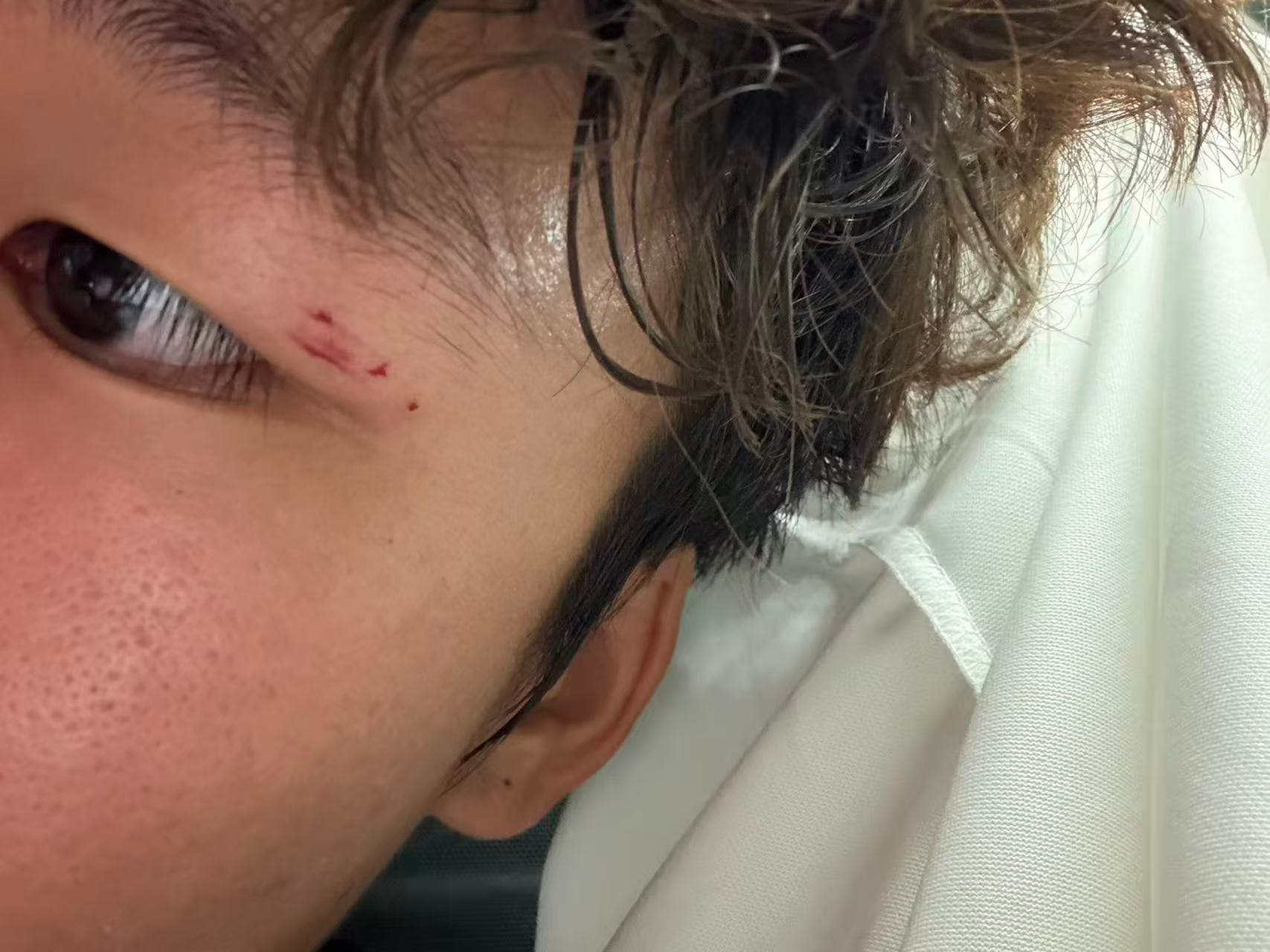 A close-up of the small scrapes near my eye after football